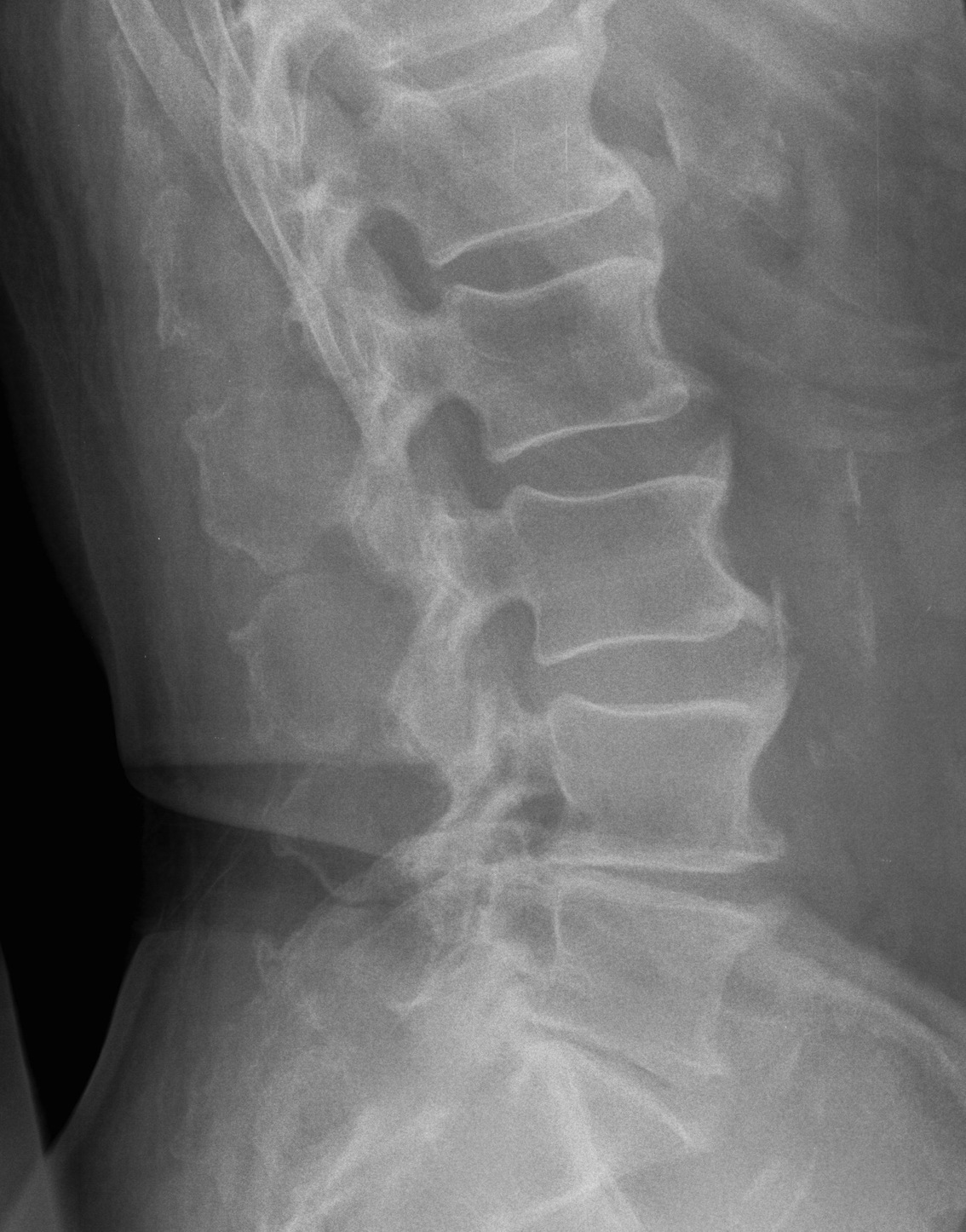 Lumbar DISH Lateral